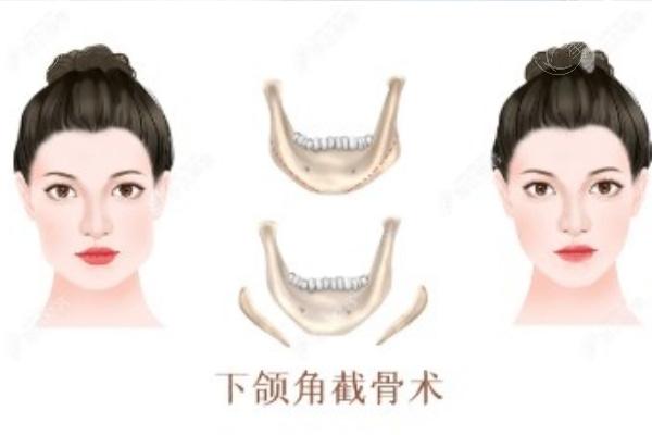 下颌骨截骨术