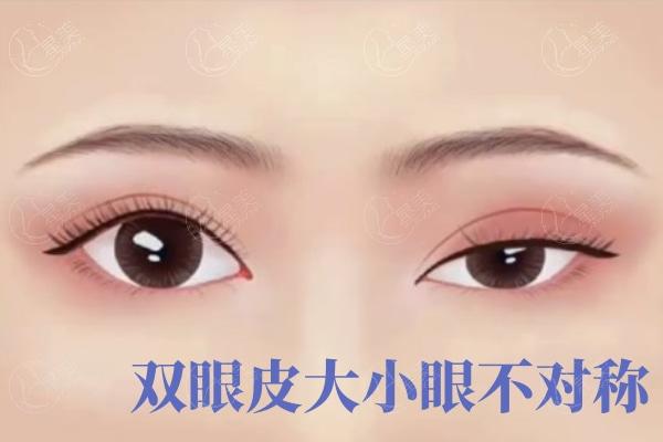 双眼皮过宽