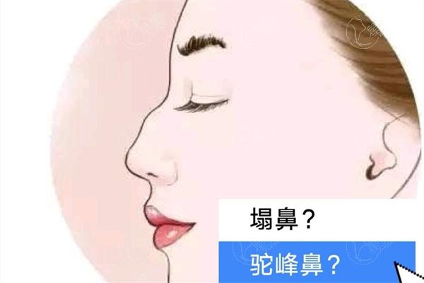 隆胸