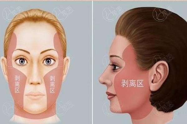 上海拉皮手术费多少钱?方案不同技术不同价格也不同
