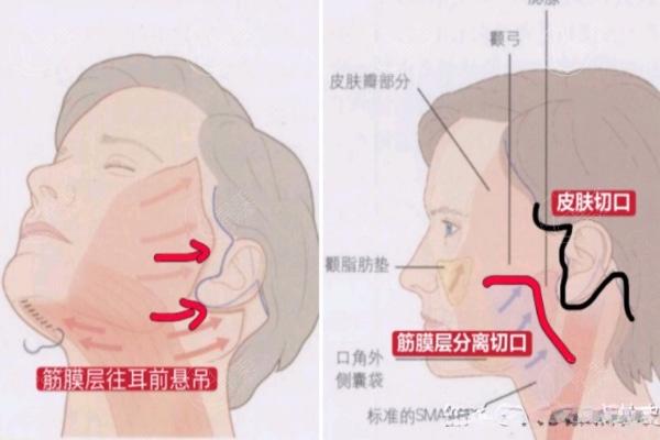 上海拉皮手术费多少钱?方案不同技术不同价格也不同