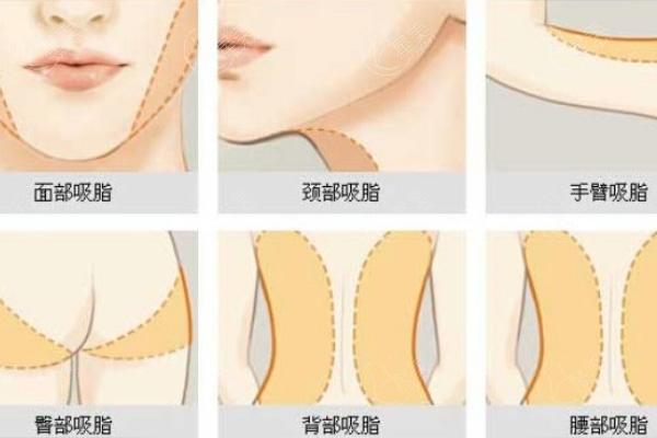 北京做吸脂手术哪家强