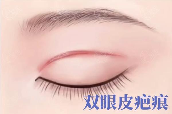 上海爱尚丽格双眼皮修复怎么样