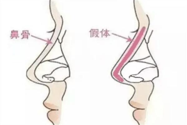 南京做鼻子好的医生排行榜