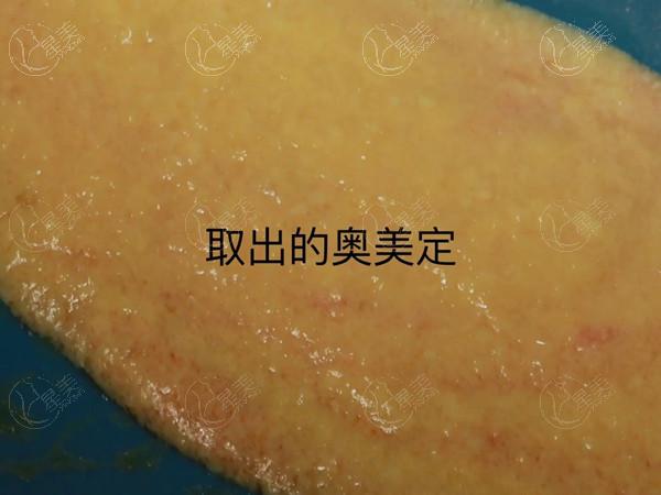 奥美定不取的危害
