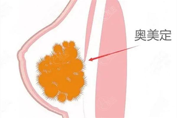 奥美定取出价格一览