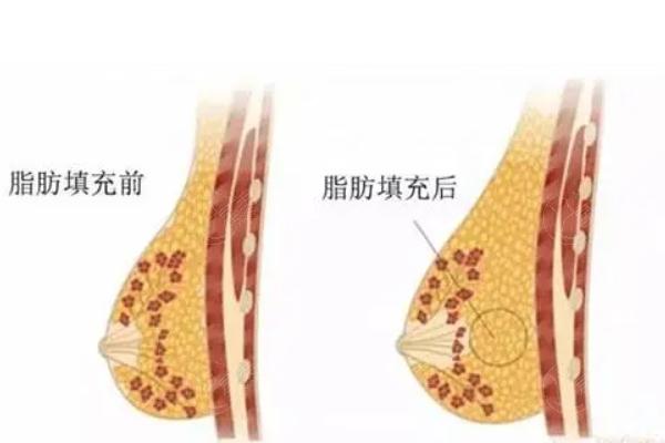 珠海正规隆胸医院推荐前五名