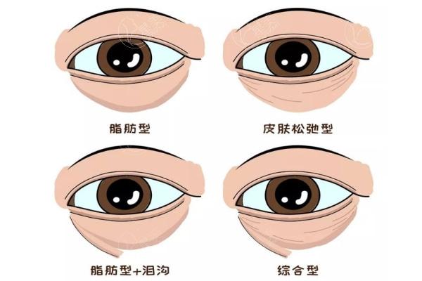 杭州双眼皮修复医生推荐