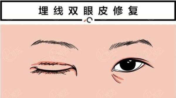 北京双眼皮修复技术牛的医生名单:全是北京做眼修复正规医院医生