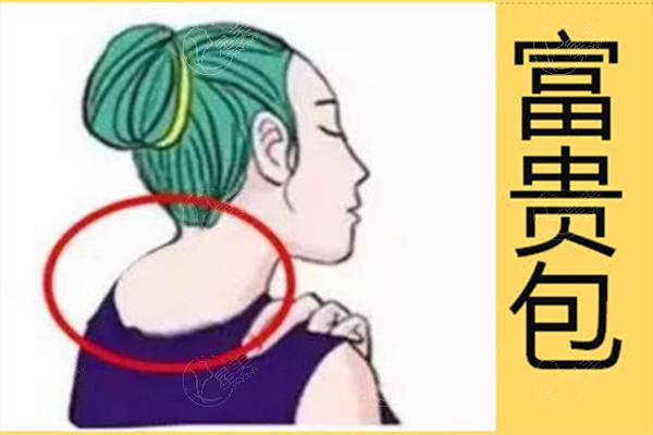 富贵包手术哪个医院做的比较好