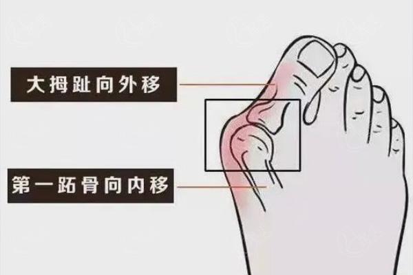重庆做脚趾拇指矫正多少钱？拇外翻矫正单只脚15000元起步价格表公布！