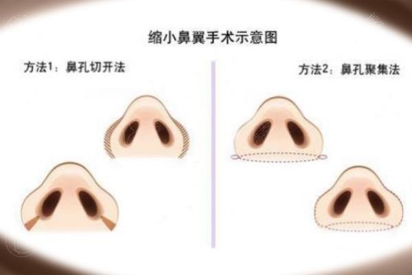 北京做鼻子和鼻修复有名的医生名单:巫文云/薛志强/刘彦军等做高难度鼻修复技术好更出名!