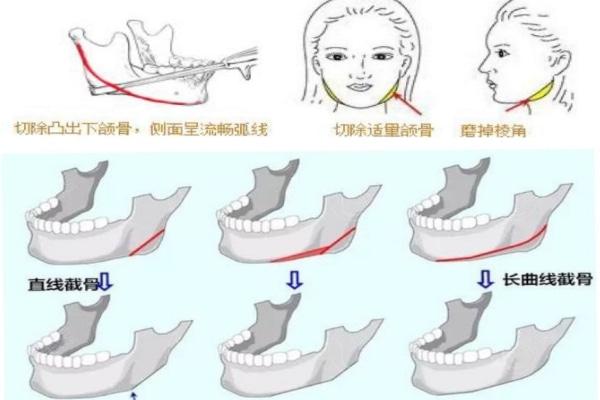 韩国削骨瘦脸要多少钱?颧骨颧弓磨骨3w+/下颌角削骨3w+/轮廓三件套9w+