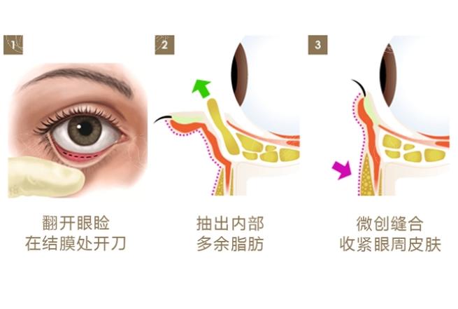 王杨医生卧蚕去眼袋的收费与技术优势解析
