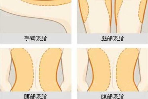 包头做吸脂多少钱一次?腰腹环吸+手臂吸脂去哪家医院更可靠?