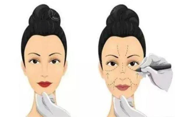姜洪涛双眼皮修复手术靠谱吗？