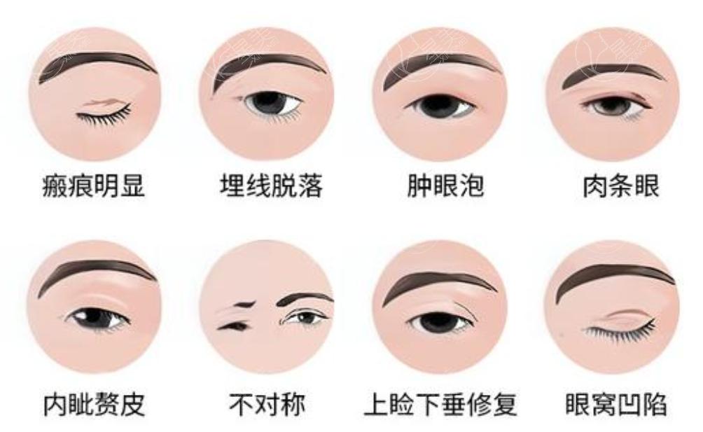姜洪涛双眼皮修复手术靠谱吗？