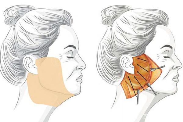 筋膜提升的显著成效