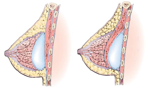 成都隆胸医生庄建波怎么样？