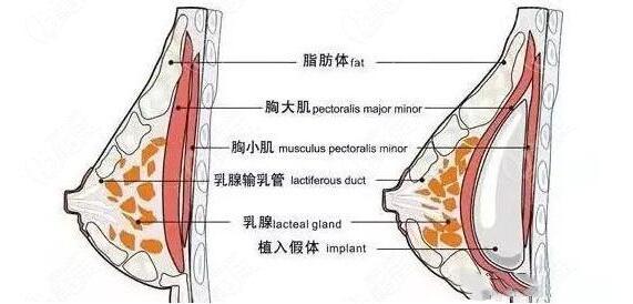 庄建波医生的隆胸手术实例与口碑