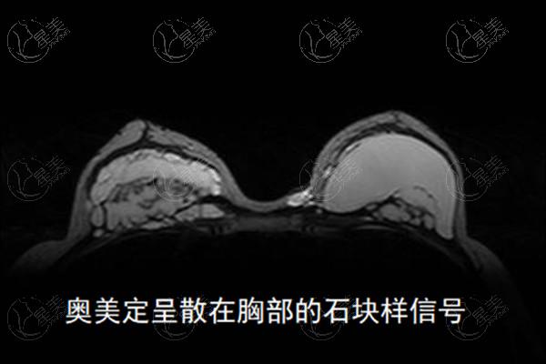 国内异物取出手术多少钱？