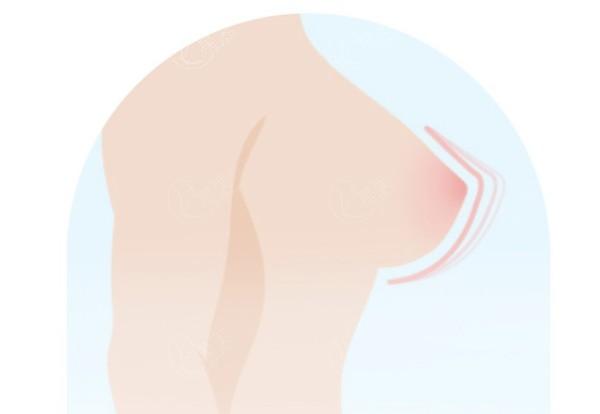 隆胸北京哪家做得比较好？北京隆胸十大整形医院是画美/艺星/美莱等前十医院