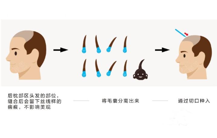 在泰国植发比国内便宜吗?这里有国内和泰国植发价格对比哟
