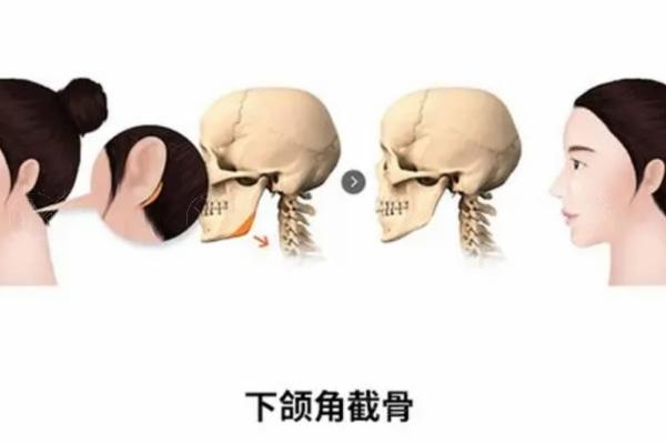 广大何绵泉做的正颌手术成效怎样?3d导板正颌技术牛45000元起