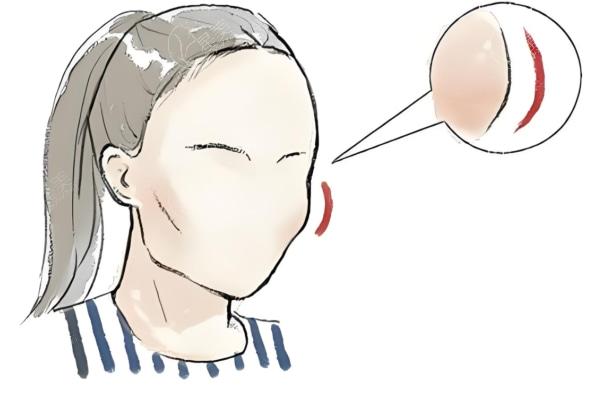 广大何绵泉做的正颌手术成效怎样?3d导板正颌技术牛45000元起