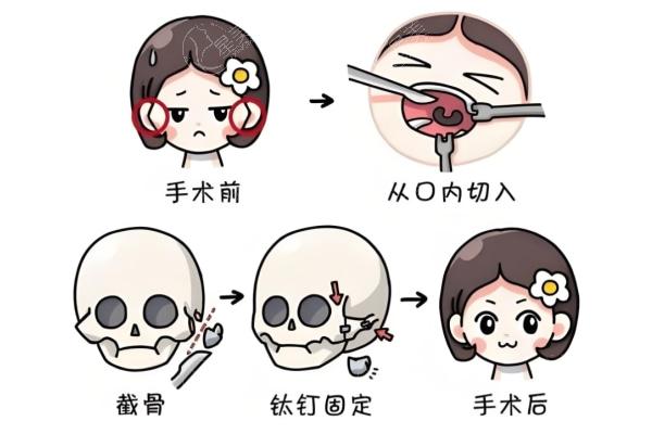 广大何绵泉做的正颌手术成效怎样?3d导板正颌技术牛45000元起
