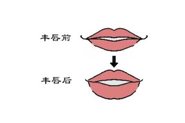 玻尿酸丰唇哪个品牌好？对比姣兰/瑞蓝/乔雅登等品牌的维持时长及价格看看吧