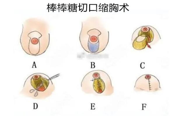 国内缩胸手术技术好的医院有哪些