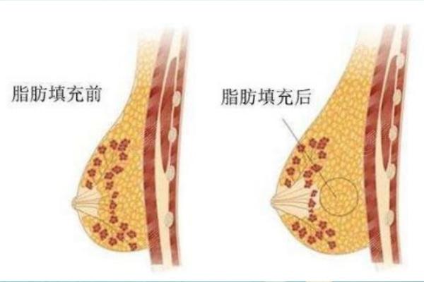 南京美莱夏建军极速丰胸价格4-6w起!收费略贵但技术超值24小时即可出院