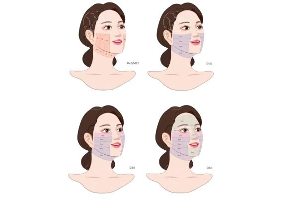 韩国做美版超声好的医院有哪些?vsline/shinebom/伊美芝中韩同价技术可靠