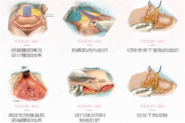 广州做腹壁成形术排名前三的医院分享:均是广州腹壁整形术真正好的医院