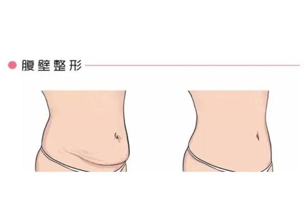 广州做腹壁成形术排名前三的医院分享:均是广州腹壁整形术真正好的医院