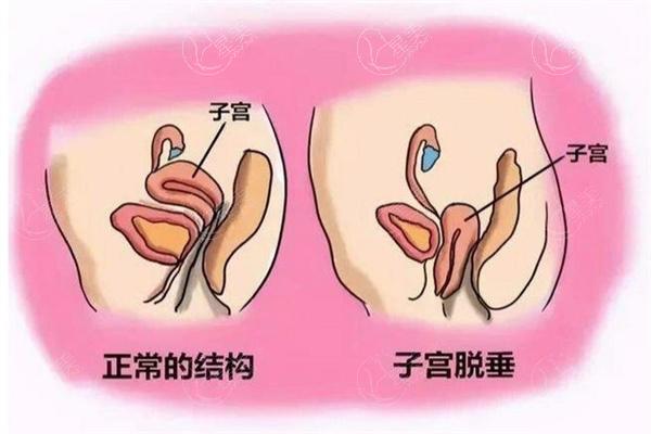 国内治疗子宫脱垂医院排名榜分享:北上广等多地实力妇科医院资质可靠评分高