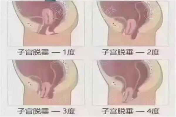 国内治疗子宫脱垂医院排名榜分享:北上广等多地实力妇科医院资质可靠评分高