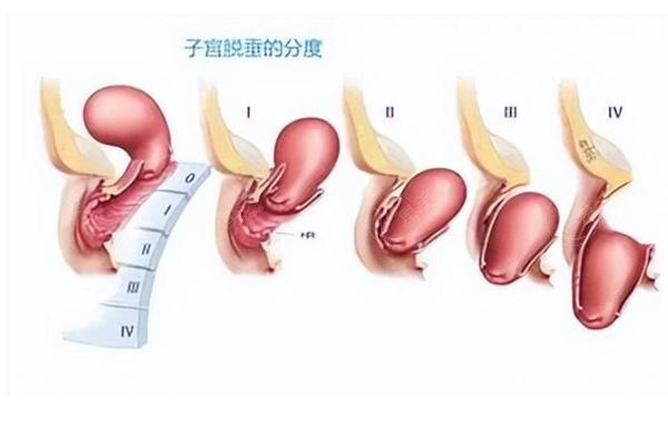 国内治疗子宫脱垂医院排名榜分享:北上广等多地实力妇科医院资质可靠评分高