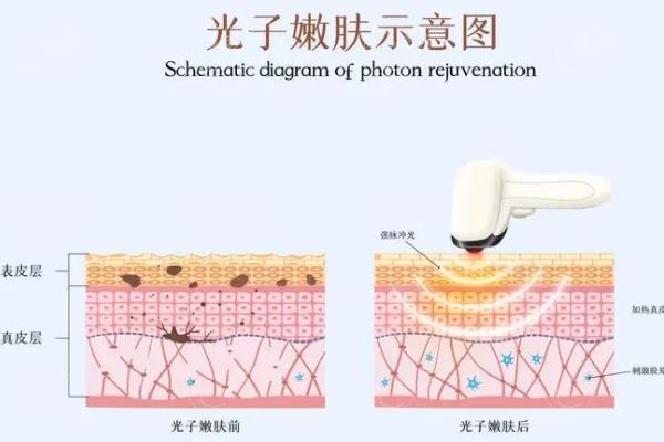 盐城激光祛斑哪家医院好