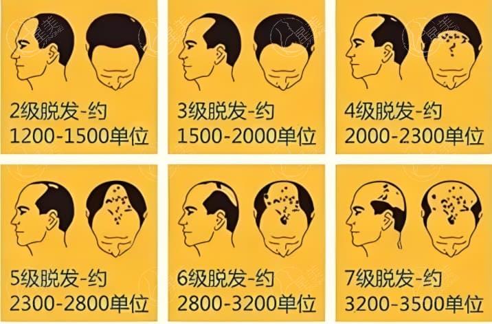 合肥头发种植技术好的医院排名