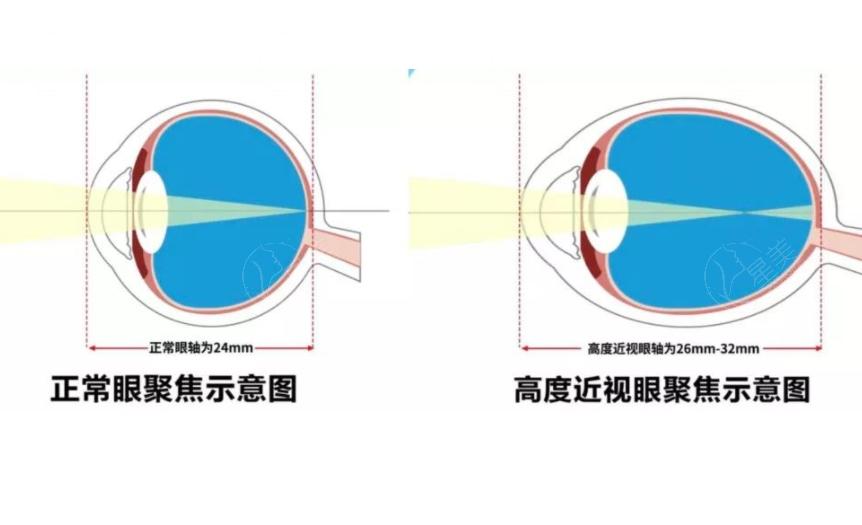 2025年爱尔眼科价格收费表更新