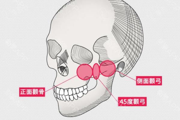 国内颧骨颧弓整形医生排行，