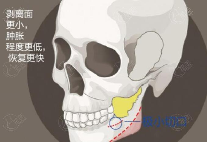 国内颧骨颧弓整形医生排行，