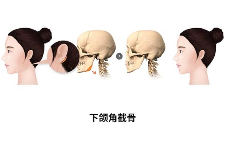 国内颧骨颧弓整形医生排行，