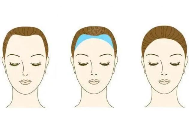 哈尔滨大麦微针植发医院怎么样