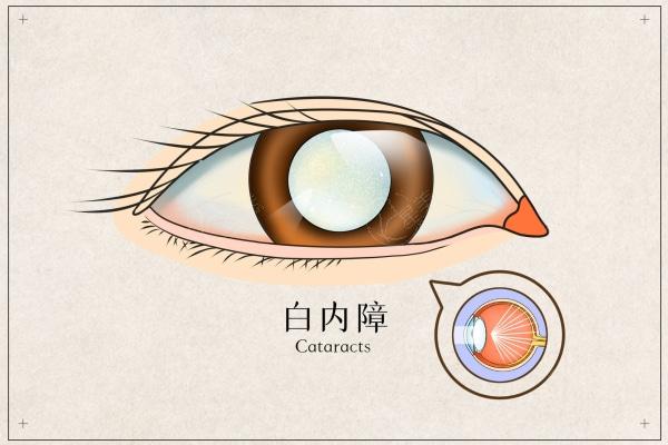 杭州近视眼手术价格