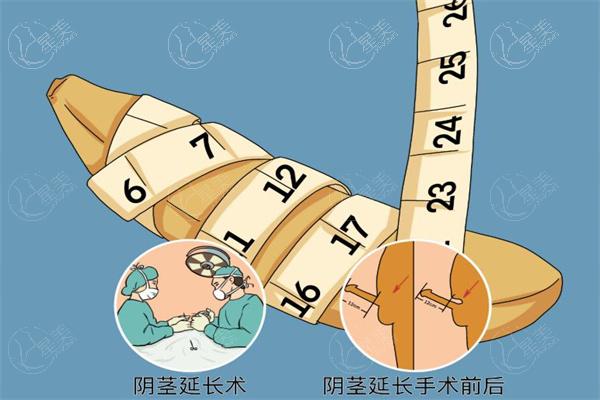 李世荣延长手术有多牛?仅凭手挤压耻骨就能预估患者的延长潜力哦!