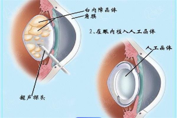 多焦点人工晶体价格多少钱?收费显示约6千起!来看新无极/全视觉/三焦晶体怎么选吧