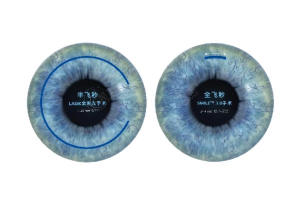 2025激光近视手术价格表在线查询